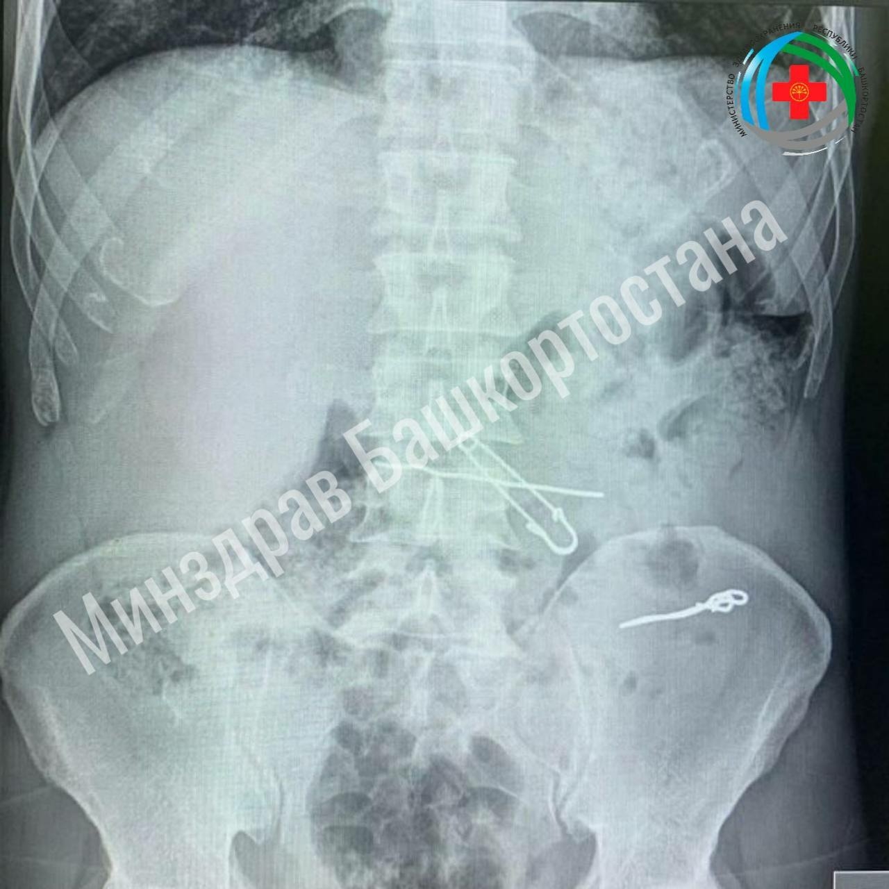 В Уфе из желудка мужчины извлекли металлические предметы