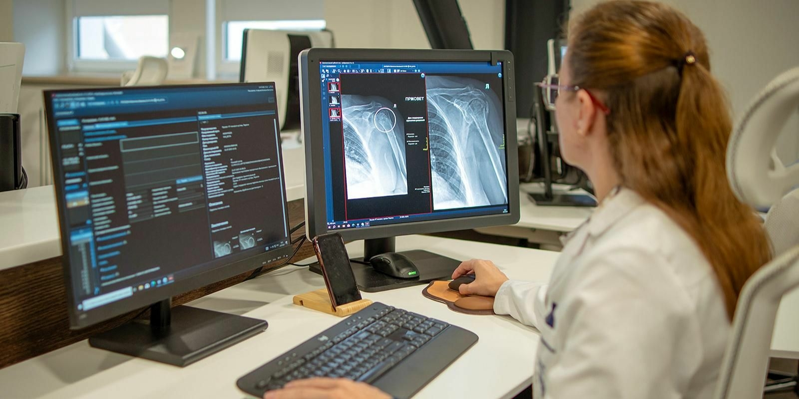 Московские врачи начали использовать ИИ для диагностики переломов плеча