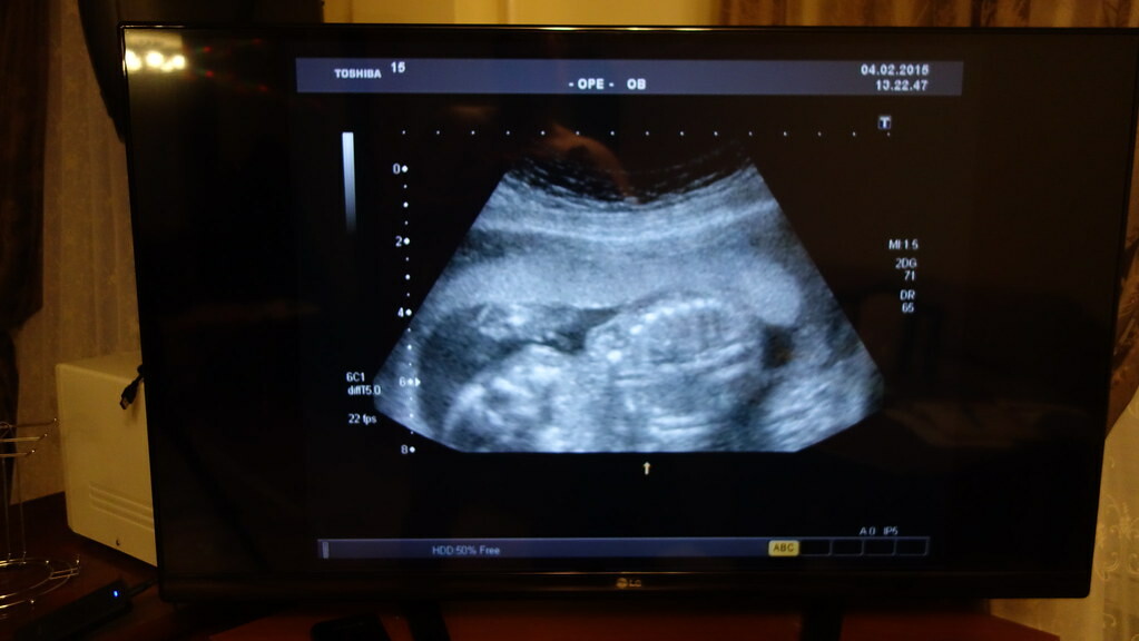 УЗИ-диагностика в Запорожской области доступна лишь на треть